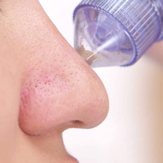 Eloxee 4-in-1 blackhead remover blue – product view 3
